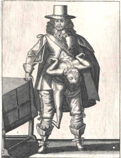 Уроженец Генуи Ладзаро Коллоредо и его близнец-паразит Джованбаттиста