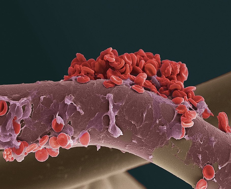 На волокне фильтра представлены слипающиеся эритроциты