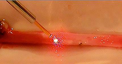 Лазерная сварка кровеносного сосуда – процесс сварки