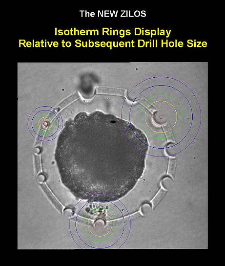Микрофотография эмбриона после серии пробных лазерных воздействий. Мощность лазерного излучения не меняется, а регулировка энергии осуществляется длительностью лазерного импульса. Изотермы (по часовой стрелке) представлены для трех значений длительности импульсов: 5 мс, 3 мс и 1 мс. Цвет окружности-изотермы: фиолетовый — 50 С, синий — 60 С, зеленый — 80 С, желтый — 100 С. Оранжевая окружность обозначает размер формируемого отверстия в оболочке 
