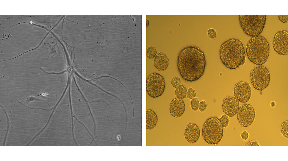 Клетка глиобластомы под большим увеличением (слева) и крупные нейросферы глиобластомы под маленьким увеличением (справа)