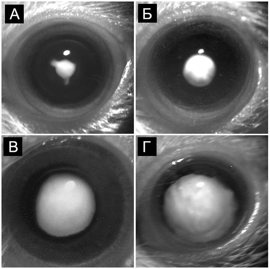 Изображение глаза с катарактой