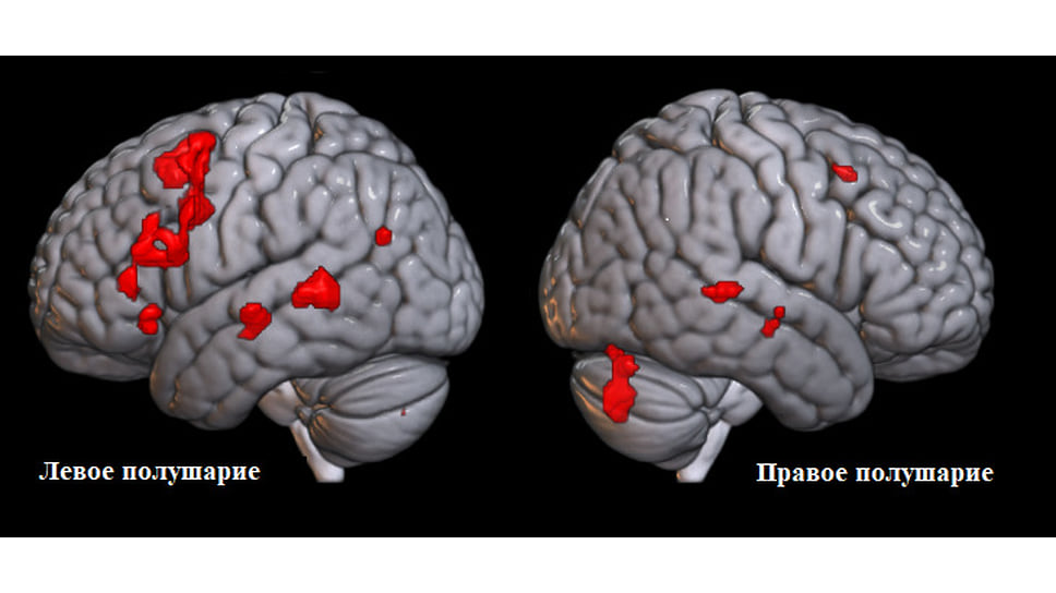 Активация при выполнении речевого задания у добровольца из контрольной группы (показана на стандартизированном изображении головного мозга)