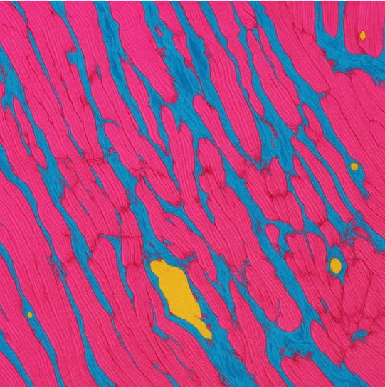 Детальная карта клеток тканей сердца. Розовые кардиомиоциты сердца, синие клетки - поражены фиброзом, желтые - соединительная ткань.