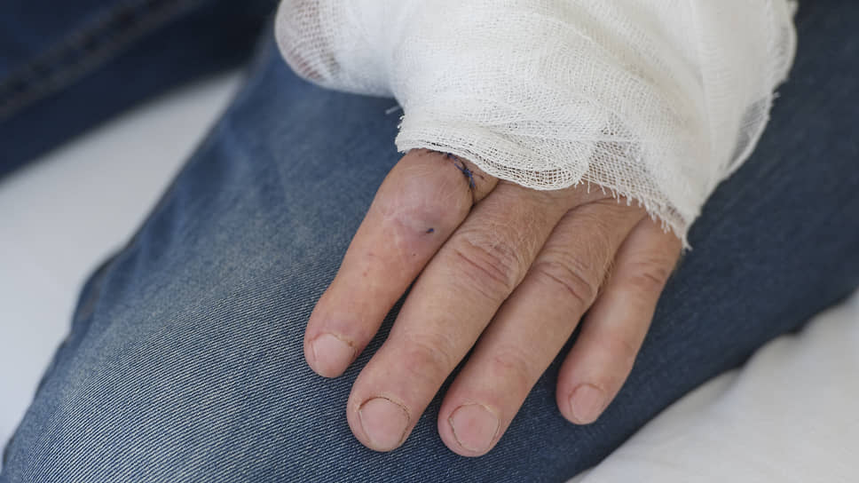 В Казани восстановили отрезанный болгаркой палец
