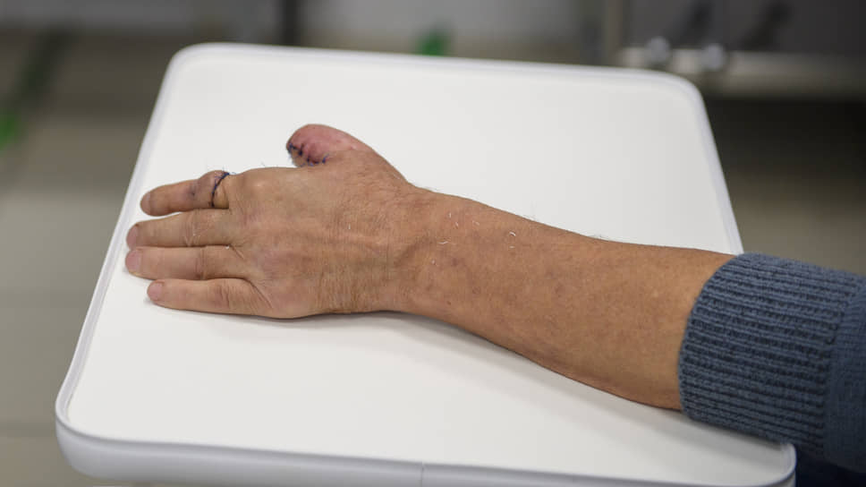 В Казани восстановили отрезанный болгаркой палец
